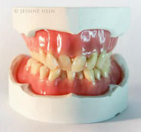 Скульптура в виде зубов Дэвида Боуи от художницы Джессин Хейн